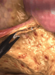 Screenshot of appendectomy training in virtual reality.