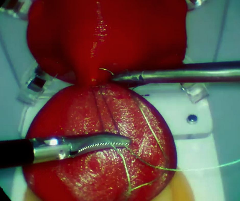 Prostatectomy training on a physical module. Stage 1: securing the Santorini plexus.