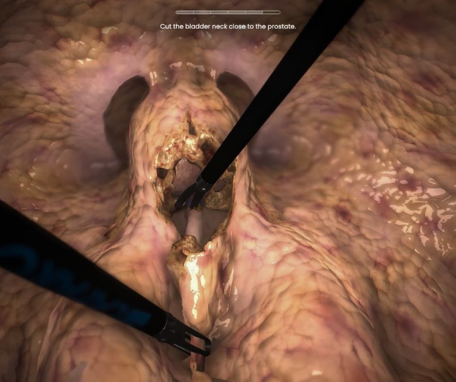 Prostatectomy training in virtual reality. Stage 2: detachment of the prostate from the bladder.