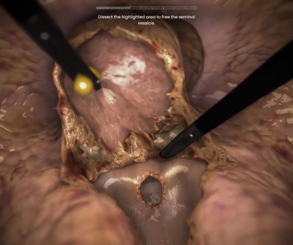 Prostatectomy training in virtual reality. Stage 3: dissection of the seminal vesicles.