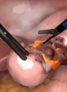 Training myomectomy in virtual reality.