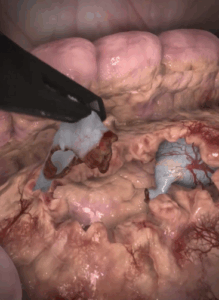 Screenshot of pyeloplasty training in virtual reality.
