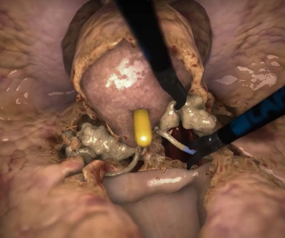 Prostatectomy training in virtual reality. Open scenario.