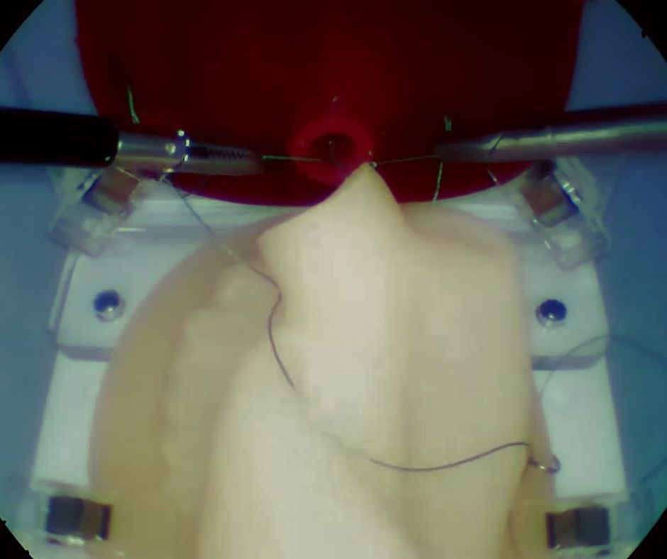 Prostatectomy training on a physical module. Stage 4: anastomosis of the bladder and urethra.