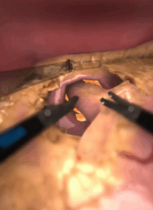 Screenshot of Nissen fundoplication training in virtual reality.