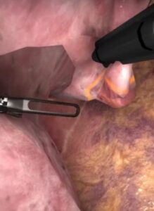 Zrzut ekranu z wirtualnego treningu resekcji klinowej płuca.