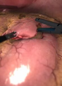 Zrzut ekranu treningu bypassu żołądkowo-jelitowego w wirtualnej rzeczywistości.