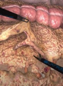 Zrzut ekranu treningu sigmoidektomii w wirtualnej rzeczywistości.