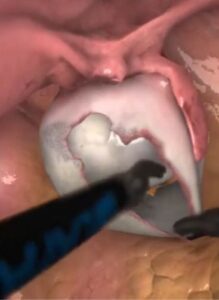 Zrzut ekranu z treningu zabiegów w obrębie jajników w wirtualnej rzeczywistości.