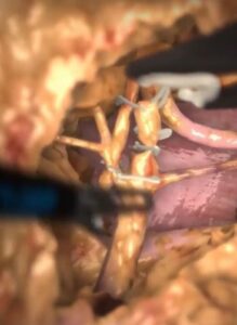 Zrzut ekranu treningu nefrektomii.