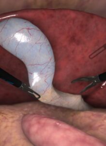 Zrzut ekranu treningu cholecystektomii w wirtualnej rzeczywistości.