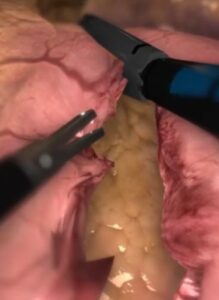 Zrzut ekranu z wirtualnego treningu rękawowej resekcji żołądka.