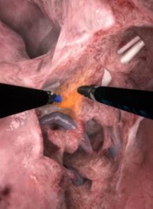 Zrzut ekranu z treningu lobektomii w wirtualnej rzeczywistości.