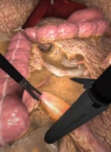 Zrzut ekranu treningu hemikolektomii w wirtualnej rzeczywistości.