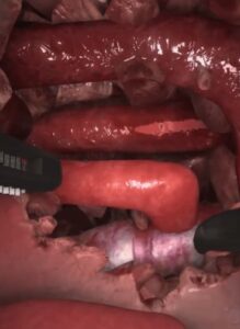 Zrzut ekranu treningu torakoskopowej naprawy atrezji przełyku w wirtualnej rzeczywistości.