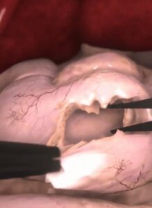 Zrzut ekranu treningu pyloromiotomii w wirtualnej rzeczywistości.