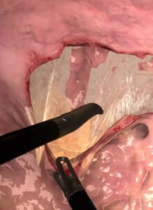 Zrzut ekranu treningu naprawy przepukliny pachwinowej w wirtualnej rzeczywistości.