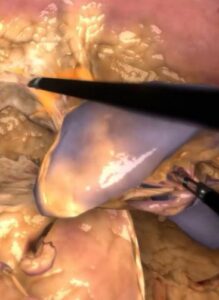 Zrzut ekranu treningu splenektomii w wirtualnej rzeczywistości.